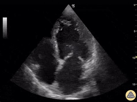 apixaban lv thrombus|apixaban vs warfarin lv thrombus.